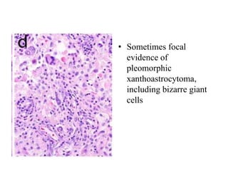 • Sometimes focal
evidence of
pleomorphic
xanthoastrocytoma,
including bizarre giant
cells
 
