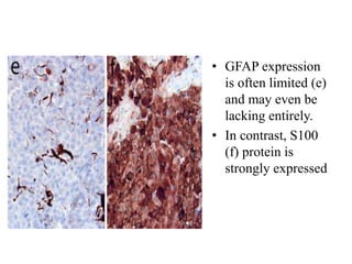 • GFAP expression
is often limited (e)
and may even be
lacking entirely.
• In contrast, S100
(f) protein is
strongly expressed
 