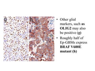 • Other glial
markers, such as
OLIG2 may also
be positive (g)
• Roughly half of
Ep-GBMs express
BRAF V600E
mutant (h)
 