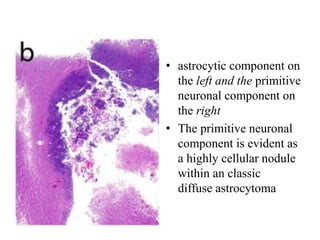 • astrocytic component on
the left and the primitive
neuronal component on
the right
• The primitive neuronal
component is evident as
a highly cellular nodule
within an classic
diffuse astrocytoma
 