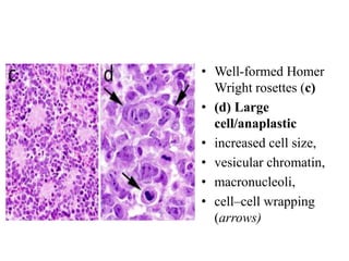• Well-formed Homer
Wright rosettes (c)
• (d) Large
cell/anaplastic
• increased cell size,
• vesicular chromatin,
• macronucleoli,
• cell–cell wrapping
(arrows)
 