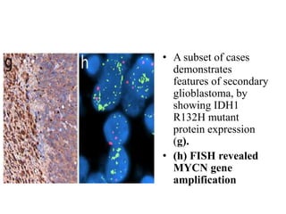 • A subset of cases
demonstrates
features of secondary
glioblastoma, by
showing IDH1
R132H mutant
protein expression
(g).
• (h) FISH revealed
MYCN gene
amplification
 