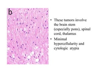 • These tumors involve
the brain stem
(especially pons), spinal
cord, thalamus
• Minimal
hypercellularity and
cytologic atypia
 