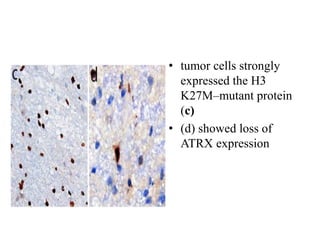 • tumor cells strongly
expressed the H3
K27M–mutant protein
(c)
• (d) showed loss of
ATRX expression
 