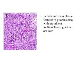 • In thalamic mass classic
features of glioblastoma
with prominent
multinucleated giant cell
are seen
 