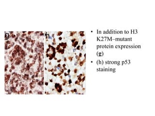 • In addition to H3
K27M–mutant
protein expression
(g)
• (h) strong p53
staining
 