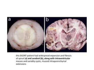 this DLGNT patient had widespread expansion and fibrosis
of spinal (a) and cerebral (b), along with intraventricular
masses and variably cystic, mucoid intraparenchymal
extensions
 