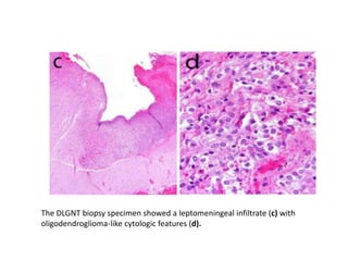 The DLGNT biopsy specimen showed a leptomeningeal infiltrate (c) with
oligodendroglioma-like cytologic features (d).
 
