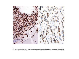 OLIG2-positive (e), variable synaptophysin immunoreactivity(f)
 
