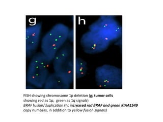 FISH showing chromosome 1p deletion (g; tumor cells
showing red as 1p, green as 1q signals)
BRAF fusion/duplication (h; increased red BRAF and green KIAA1549
copy numbers, in addition to yellow fusion signals)
 