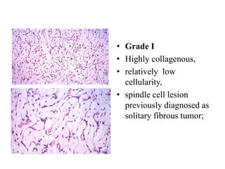 • Grade I
• Highly collagenous,
• relatively low
cellularity,
• spindle cell lesion
previously diagnosed as
solitary fibrous tumor;
 