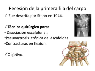 Recesión de la primera fila del carpo
 Fue descrita por Stann en 1944.
Técnica quirúrgica para:
• Disociación escafolunar.
•Pseuoartrosis crónica del escafoides.
•Contracturas en flexion.
Objetivo.
 