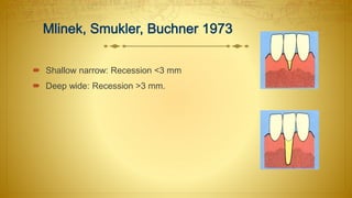  Shallow narrow: Recession <3 mm
 Deep wide: Recession >3 mm.
 