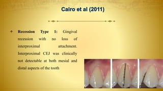  Recession Type 1: Gingival
recession with no loss of
interproximal attachment.
Interproximal CEJ was clinically
not detectable at both mesial and
distal aspects of the tooth
 