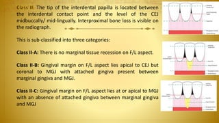 The tip of the interdental papilla is located between
the interdental contact point and the level of the CEJ
midbuccally/ mid-lingually. Interproximal bone loss is visible on
the radiograph.
This is sub-classified into three categories:
Class II-A: There is no marginal tissue recession on F/L aspect.
Class II-B: Gingival margin on F/L aspect lies apical to CEJ but
coronal to MGJ with attached gingiva present between
marginal gingiva and MGJ.
Class II-C: Gingival margin on F/L aspect lies at or apical to MGJ
with an absence of attached gingiva between marginal gingiva
and MGJ
 