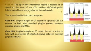 The tip of the interdental papilla is located at or
apical to the level of the CEJ mid-buccally/mid-lingually.
Interproximal bone loss is visible on the radiograph.
This is sub-classified into two categories:
Class III-A: Gingival margin on F/L aspect lies apical to CEJ, but
coronal to MGJ with attached gingiva present between
marginal gingiva and MGJ.
Class III-B: Gingival margin on F/L aspect lies at or apical to
MGJ with an absence of attached gingiva between marginal
gingiva and MGJ.
 
