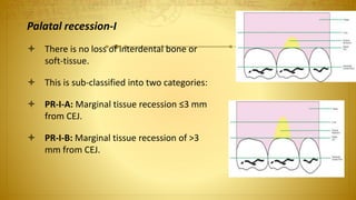 Palatal recession-I
 There is no loss of interdental bone or
soft-tissue.
 This is sub-classified into two categories:
 PR-I-A: Marginal tissue recession ≤3 mm
from CEJ.
 PR-I-B: Marginal tissue recession of >3
mm from CEJ.
 
