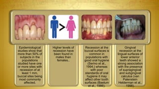Epidemiological
studies show that
more than 50% of
subjects in the
populations
studied have one
or more sites with
recession of at
least 1 mm,
buccal sites being
most commonly
affected.
Higher levels of
recession have
been found in
males than
females..
Recession at the
buccal surfaces is
common in
populations with
good oral hygiene
(Serino et al.,
1994;) whereas
with poor
standards of oral
hygiene it may
affect other tooth
surfaces (Baelum
et al., 1986).
Gingival
recession at the
lingual surfaces of
lower anterior
teeth showed a
strong association
with the presence
of supragingival
and subgingival
calculus (van
Palenstein
Helderman et al.,
1998).
 