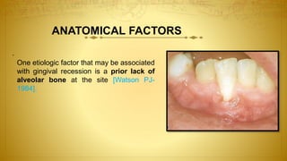 ANATOMICAL FACTORS
.
One etiologic factor that may be associated
with gingival recession is a prior lack of
alveolar bone at the site [Watson PJ-
1984].
 