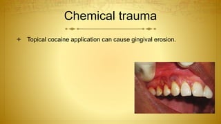 Chemical trauma
 Topical cocaine application can cause gingival erosion.
 