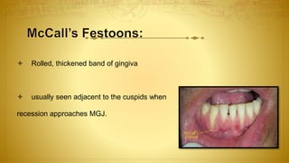  Rolled, thickened band of gingiva
 usually seen adjacent to the cuspids when
recession approaches MGJ.
 