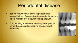 Periodontal disease
 Bone destruction will occur in periodontitis
alongwith loss of connective tissue attachment and
apical migration of the junctional epithelium.
 The resulting attachment loss may be expressed
primarily as pocket deepening or as gingival
recession.
 