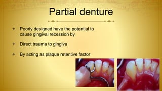 Partial denture
 Poorly designed have the potential to
cause gingival recession by
 Direct trauma to gingiva
 By acting as plaque retentive factor
 