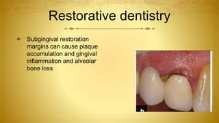 Restorative dentistry
 Subgingival restoration
margins can cause plaque
accumulation and gingival
inflammation and alveolar
bone loss
 