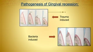 Trauma
induced
Bacteria
induced
 