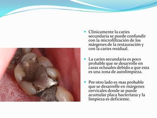  Clínicamente la caries
  secundaria se puede confundir
  con la microfiltración de los
  márgenes de la restauración y
  con la caries residual.

 La caries secundaria es poco
  probable que se desarrolle en
  caras oclusales debido a que esta
  es una zona de autolimpieza.

 Por otro lado es mas probable
  que se desarrolle en márgenes
  cervicales donde se puede
  acumular placa bacteriana y la
  limpieza es deficiente.
 
