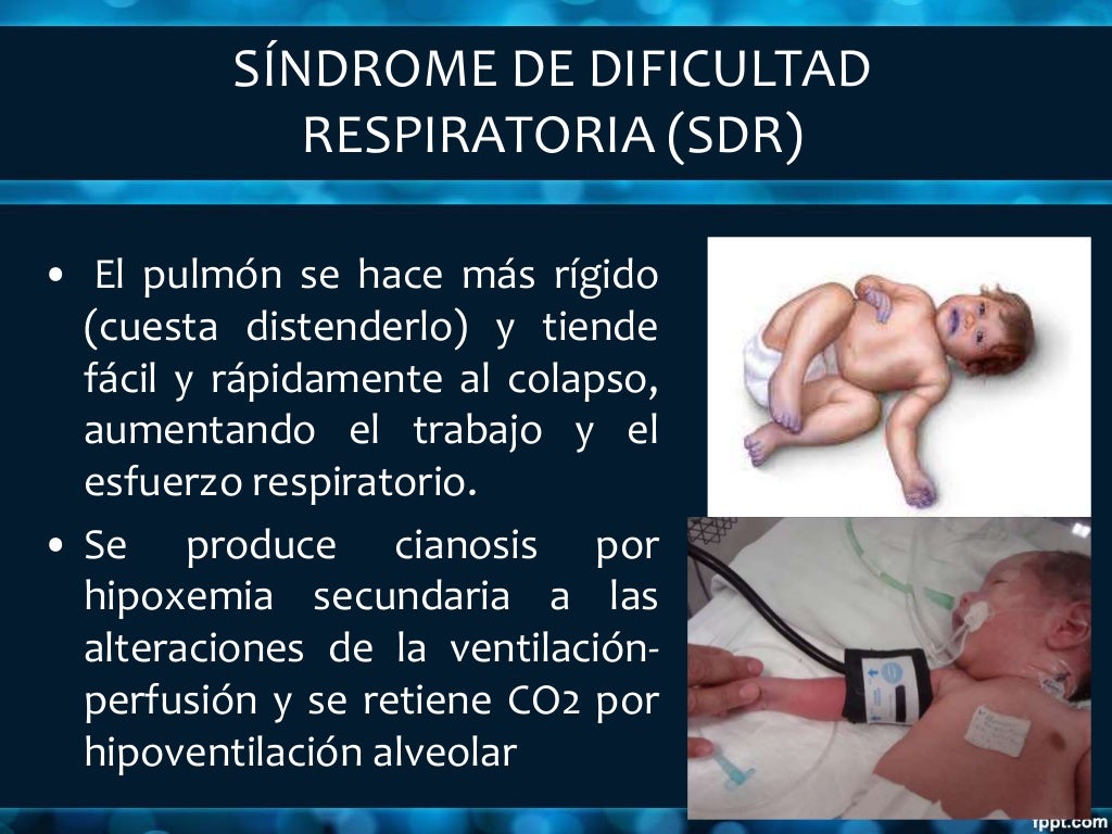 Recien nacido con dificultad respiratoria Enfoque diagnóstico y tera… Recien nacido con dificultad respiratoria Enfoque diagnóstico y tera…