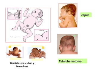 Genitales masculino y
femeninos
caput
Cefalohematoma
 