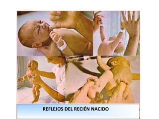 REFLEJOS DEL RECIÉN NACIDO
 