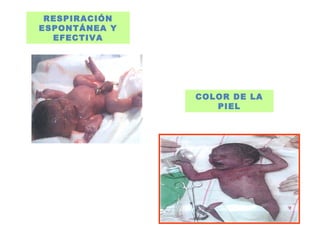 RESPIRACIÓN
ESPONTÁNEA Y
EFECTIVA
COLOR DE LA
PIEL
 