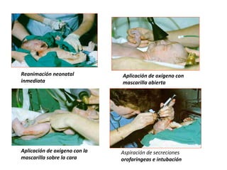 Reanimación neonatal
inmediata
Aplicación de oxígeno con
mascarilla abierta
Aplicación de oxígeno con la
mascarilla sobre la cara
Aspiración de secreciones
orofaringeas e intubación
 