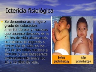 Ictericia fisiológica  Se denomina así al ligero grado de coloración amarilla de piel y mucosas que aparece después de la 24 hrs de vida alcanzando su máximo al segundo o tercer día de vida en los 2/3 de los niños nacidos a término y que desaparece ordinariamente entre los 10 y 12 días de vida.  