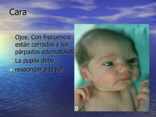 Cara Ojos: Con frecuencia están cerrados y los párpados edematosos  La pupila debe  responder a la luz .  