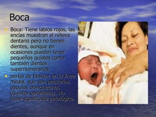 Boca  Boca: Tiene labios rojos, las encías muestran el relieve  dentario pero no tienen dientes, aunque en ocasiones pueden tener pequeños quistes como también dientes supernumerarios  perlas de Ebstein en la línea media, que son pequeñas pápulas blanquecinas (quistes epiteliales). No tiene significado patológico. 
