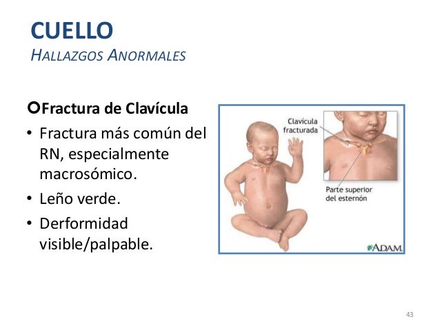 Hematoma Retrocorial Y Síndrome De Down