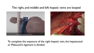 Recipient hepatectomy in liver transplantation | PPTX