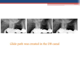 Glide path was created in the DB canal
 