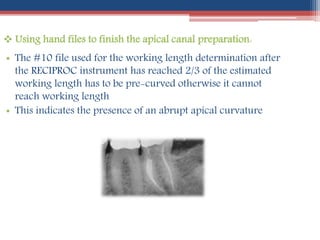  Using hand files to finish the apical canal preparation:
• The #10 file used for the working length determination after
the RECIPROC instrument has reached 2/3 of the estimated
working length has to be pre-curved otherwise it cannot
reach working length
• This indicates the presence of an abrupt apical curvature
 