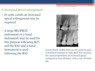  Increased apical enlargement :
• In some canals an increased
apical enlargement may be
required
• A large RECIPROC
instrument or a hand
instrument may be used for
this purpose following R25
and the R40 and a hand
instrument is used
following the R50
Canal Clearly visible from access cavity to apex
Considered medium or wide (R25 was used for
the canal preparation; an increased apical
enlargement was obtained with a size 70 hand
file.
 