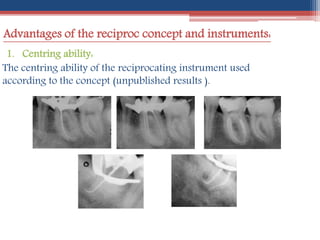Advantages of the reciproc concept and instruments:
1. Centring ability:
The centring ability of the reciprocating instrument used
according to the concept (unpublished results ).
 