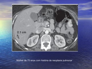 Mulher de 75 anos com história de neoplasia pulmonar
 