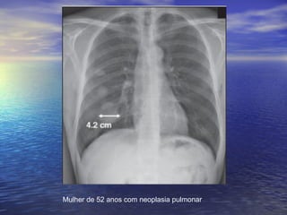 Mulher de 52 anos com neoplasia pulmonar
 