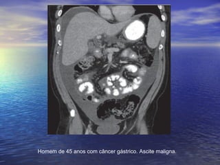 Homem de 45 anos com câncer gástrico. Ascite maligna.
 