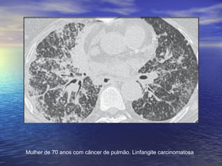 Mulher de 70 anos com câncer de pulmão. Linfangite carcinomatosa
 