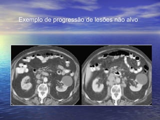 Exemplo de progressão de lesões não alvo
 