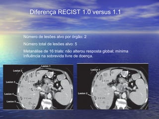 Diferença RECIST 1.0 versus 1.1


Número de lesões alvo por órgão: 2
Número total de lesões alvo: 5
Metanálise de 16 trials: não alterou resposta global; mínima
influência na sobrevida livre de doença.
 